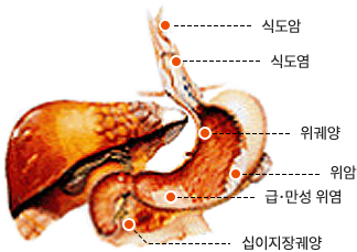 위장질환